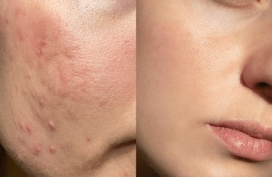 How to Remove Dead Skin Naturally Without Harsh Scrubs?
