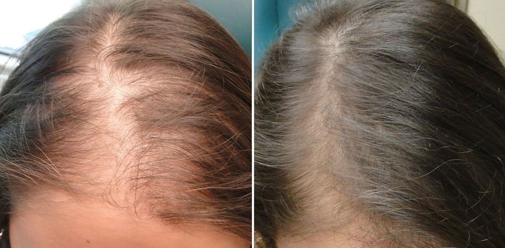 Korean Ginseng for Hair Growth—Does It Really Work?