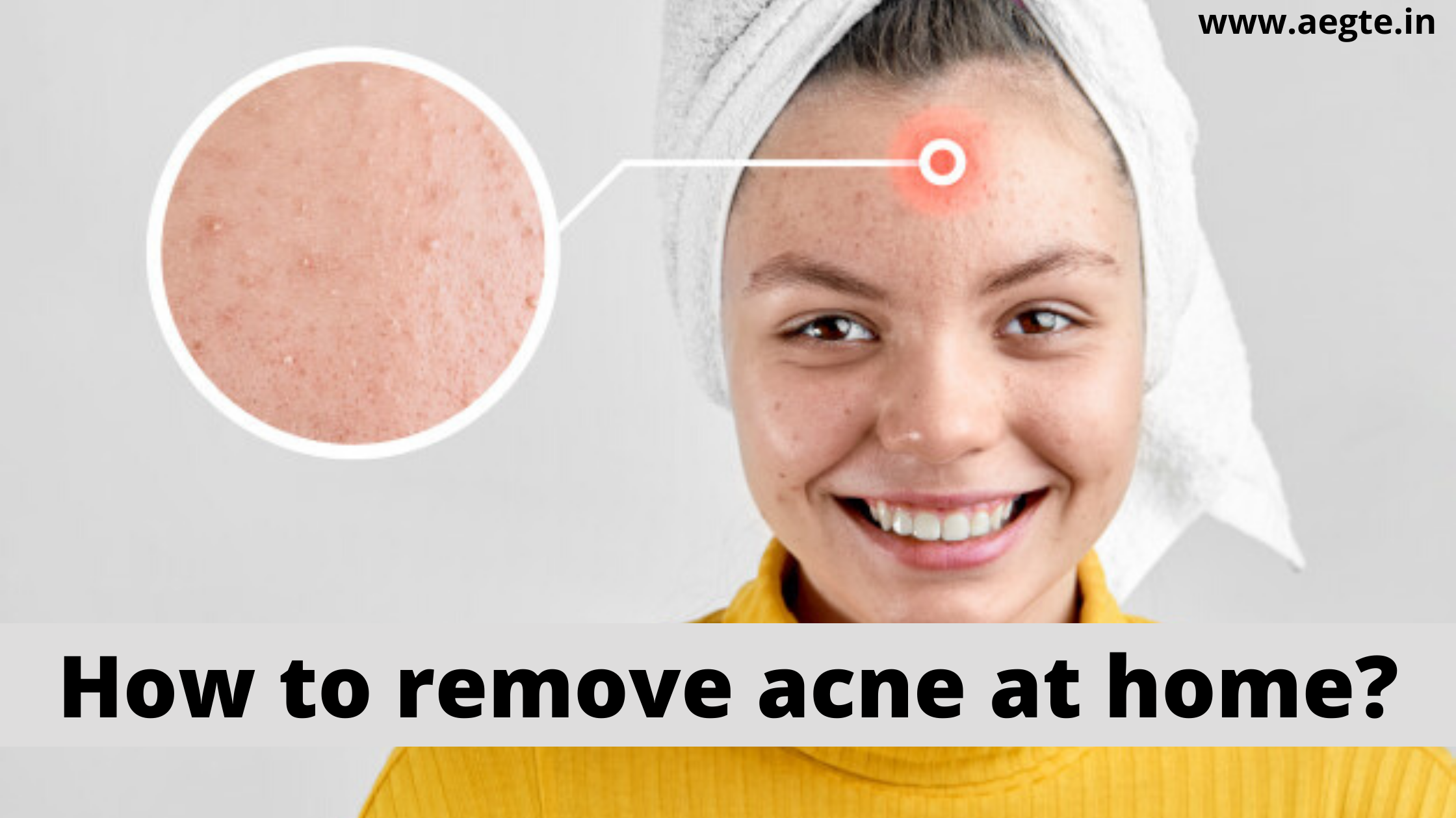 How to remove acne at home?