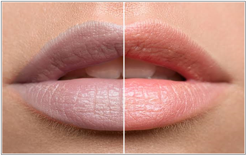How to Lighten Dark and Pigmented Lips?