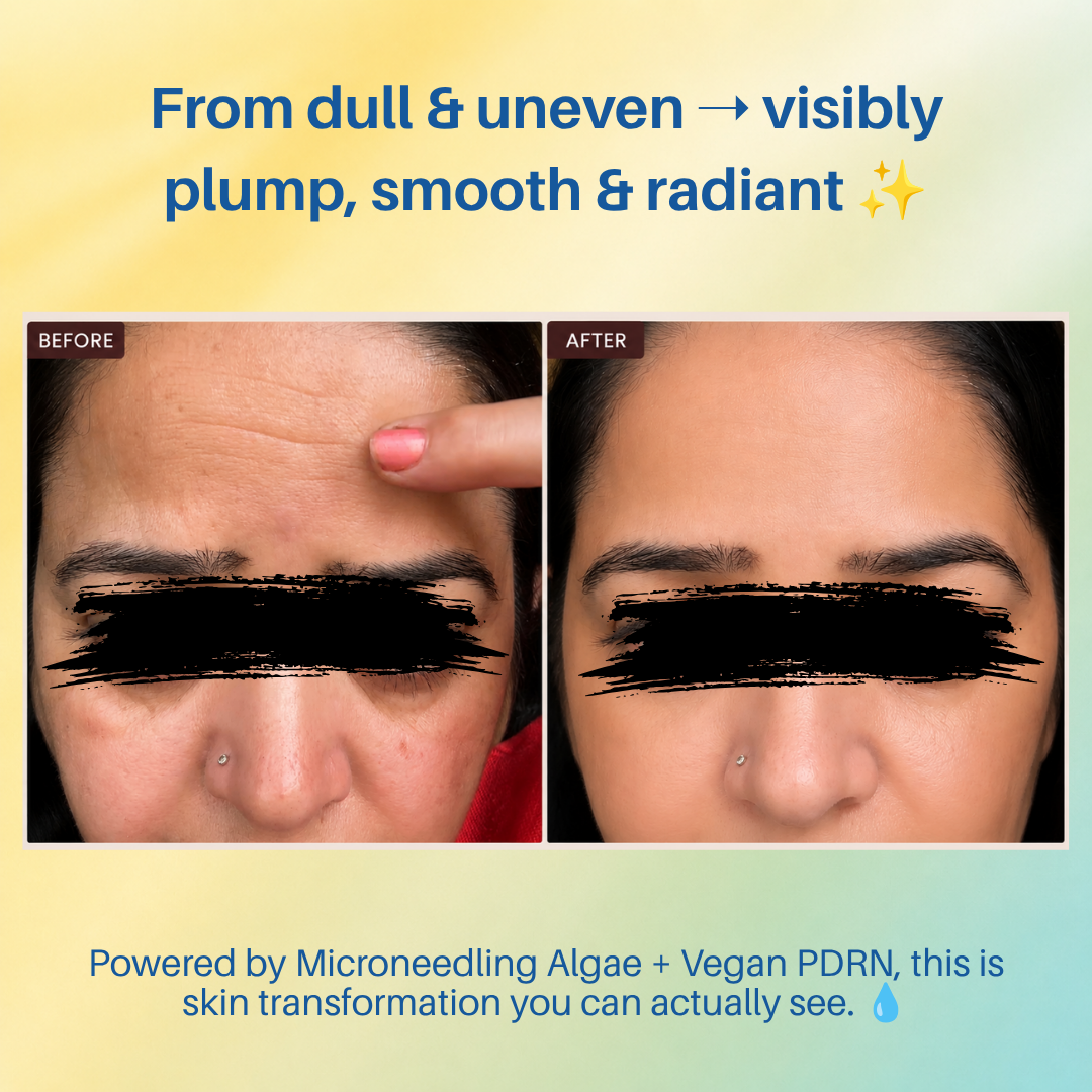 Aegte Hylu-Collagen Advanced Skin Booster With Microneedling Algae & Vegan PDRN
